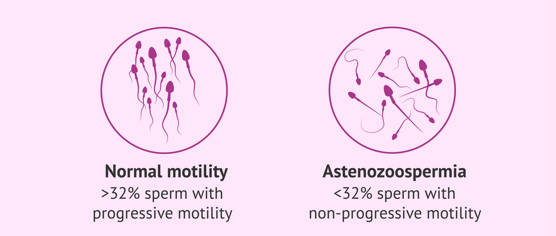 Asthenozoospermia: Causes and Infertility Solutions